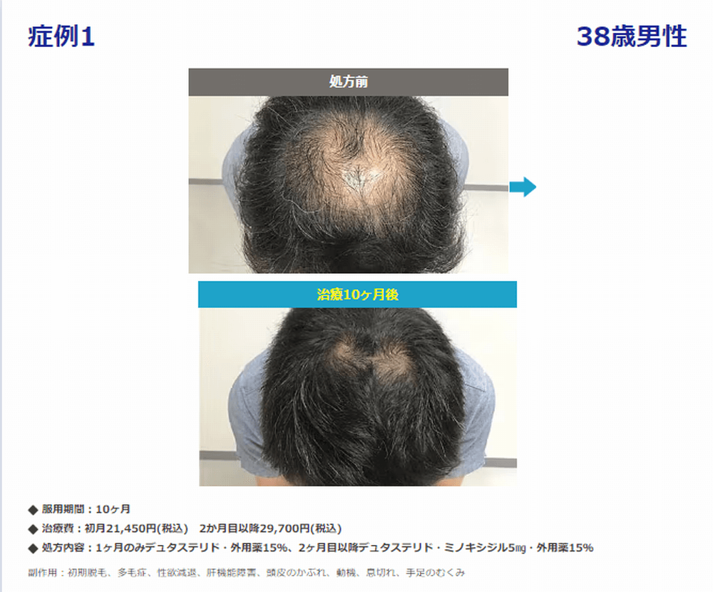 AGA治療で10か月後に薄毛が改善している画像