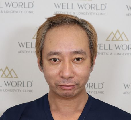 いしだ壱成のおでこがハゲになった画像